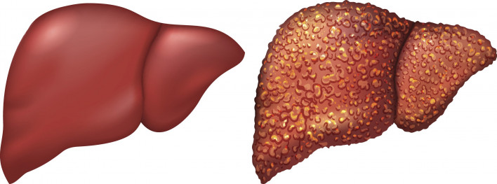 Symptoms of Liver Cirrhosis